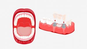 کاشت دندان – ایمپلنت